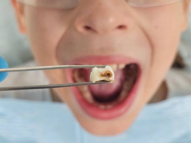 Best Emergency Treatment for Dental Infections or Abscesses in Highland, IL