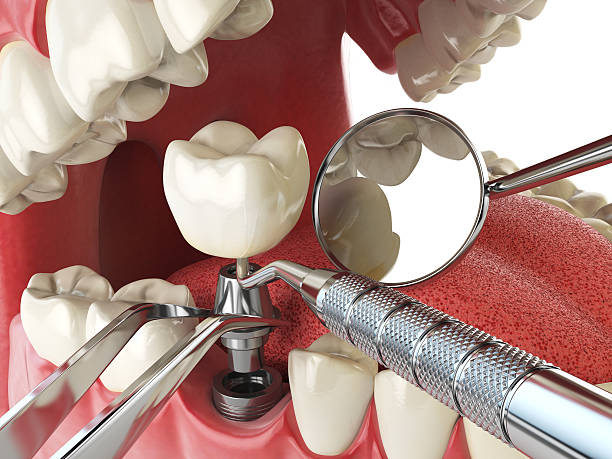 Best Emergency Wisdom Teeth Removal in Highland, IL